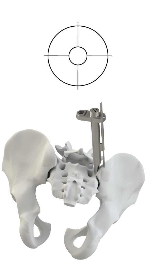 transfasten posterior si fusion system single implant dock