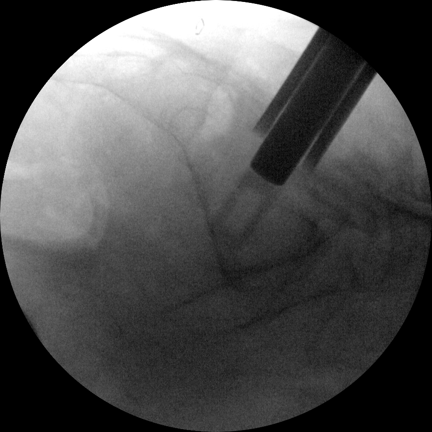 transfasten posterior si fusion system xray implant si joint